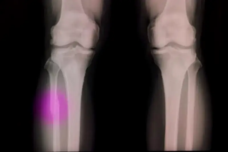 অপারেশন থিয়েটারে গ্লু গান! হাড়ের গর্ত সারাবে জৈবিক আঠা