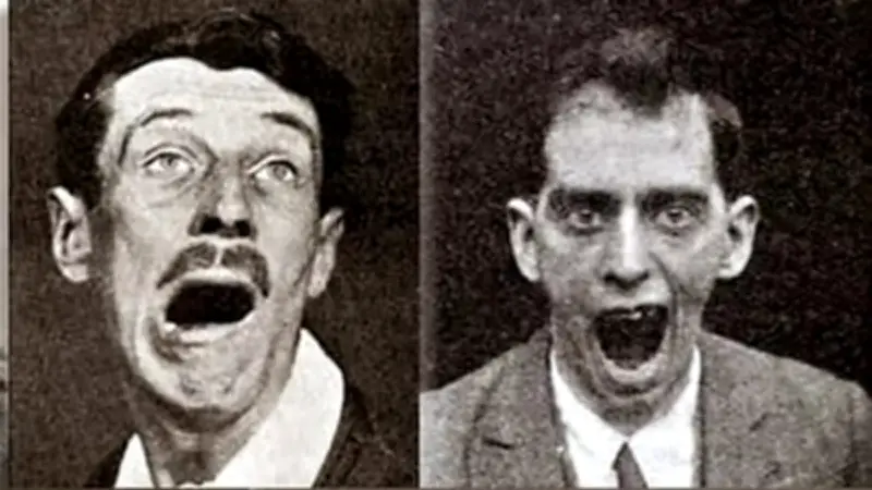 এনসেফালাইটিস লিথার্জিকা: ১৯১৬ সালের সেই রহস্যময় ঘুমের রোগের অজানা ইতিহাস