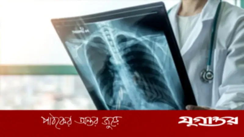 মালয়েশিয়ায় যক্ষ্মা সংক্রমণ উদ্বেগজনক হারে বৃদ্ধি, স্বাস্থ্য মন্ত্রণালয়ের বিশেষ সতর্কতা