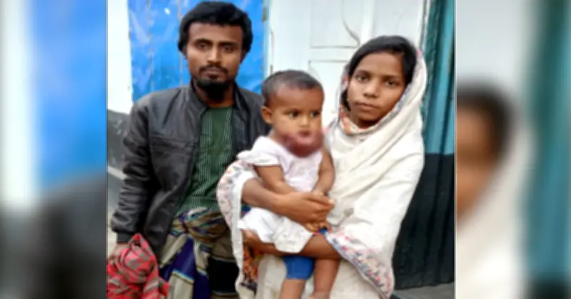 নওগাঁর শিশু মেঘার বিরল টিউমার: দরিদ্র পরিবারের জন্য চিকিৎসা সংকট