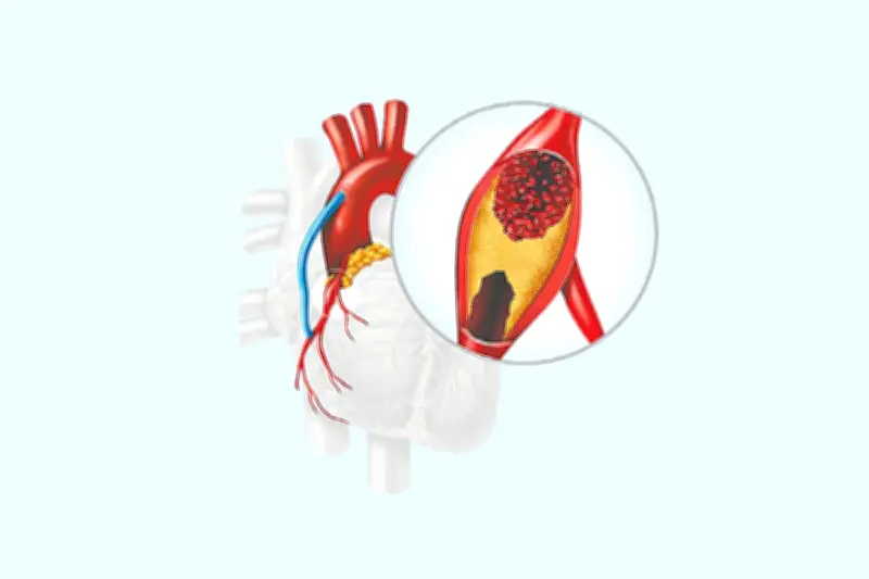 করোনারি হৃদরোগ: লক্ষণ, ব্লক শনাক্ত ও এনজিওগ্রামের গুরুত্ব