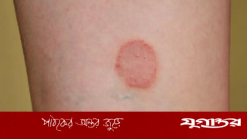 দাদ রোগ থেকে মুক্তি পেতে ঘরোয়া উপায়: বিশেষজ্ঞদের পরামর্শ ও কার্যকরী সমাধান
