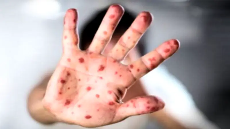 বিশ্বজুড়ে হামের ভয়াবহ সংক্রমণ বৃদ্ধি, নেপথ্যে টিকার বাইরে থাকা শিশুদের ঝুঁকি