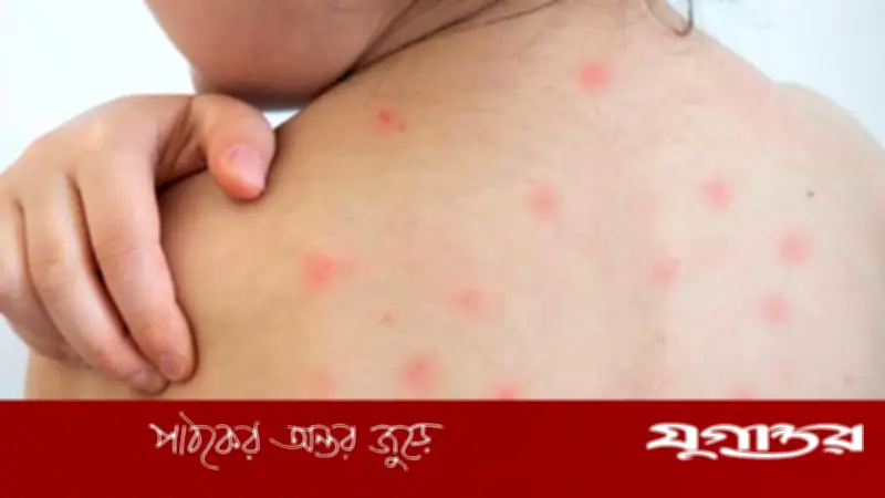 হামের প্রাদুর্ভাব: সংক্রমণ ছড়ানোর পথ, লক্ষণ ও প্রতিকার