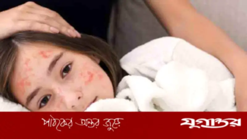 হামে আক্রান্ত শিশুর পুষ্টি: কোন খাবার খাওয়াবেন, কোনগুলো এড়াবেন