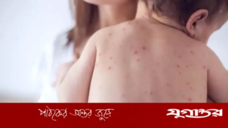 রংপুরে হামের প্রাদুর্ভাব: রমেক হাসপাতালে ৪ শিশু ভর্তি, বিভাগে ১১৬ সন্দেহভাজন