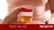 হলুদ প্রস্রাব কি ডায়াবিটিসের লক্ষণ? চিকিৎসকদের ব্যাখ্যা