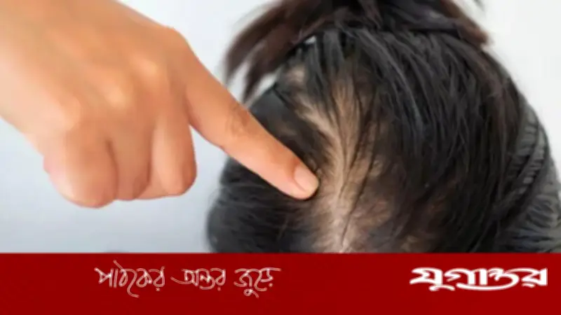 চুল পড়ার পেছনের ৫টি প্রধান কারণ: পুষ্টির ঘাটতি থেকে সাবধান