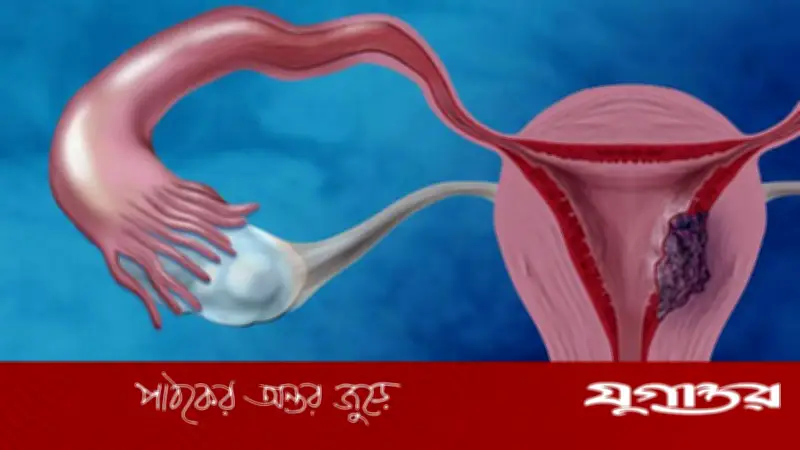 অনিয়মিত ঋতুস্রাব জরায়ুর ক্যানসারের সতর্ক সংকেত হতে পারে