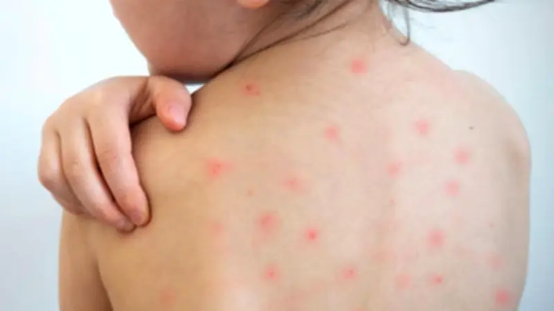 দেশে হামে আরো ৪ শিশুর মৃত্যু, আক্রান্ত ৬৮৫ জন; পাকিস্তানি বন্দরে যান চলাচল বেড়েছে