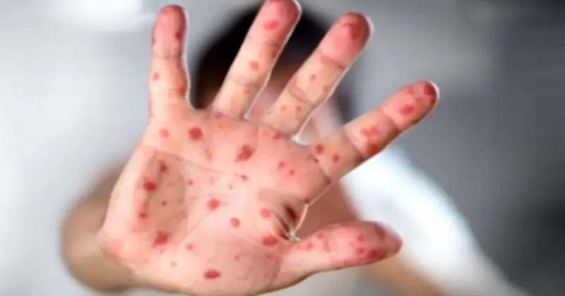 গত ২৪ ঘণ্টায় হামে আক্রান্ত হয়ে ৪ জনের মৃত্যু, নতুন আক্রান্ত ৬৮৫