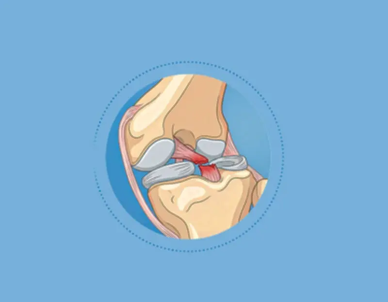হাঁটুর লিগামেন্ট ও মেনিসকাস ছেঁড়ার লক্ষণ, প্রাথমিক চিকিৎসা ও প্রতিকার