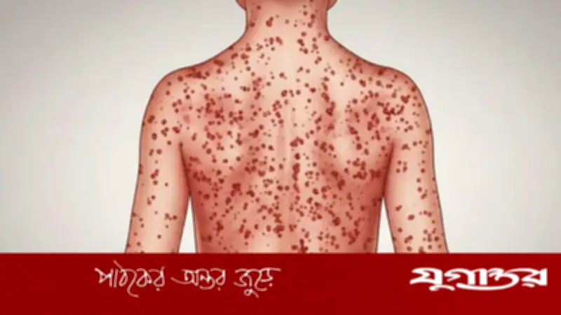 হামের ঝুঁকিতে ২০ জেলার ৩০ এলাকা: বিশেষ টিকাদান কর্মসূচি শুরু হচ্ছে