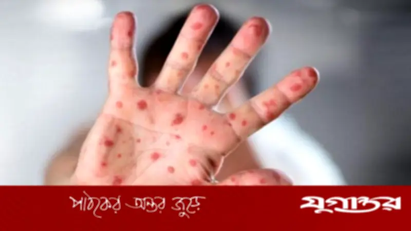 হামের প্রকোপে উদ্বেগ: ২৪ ঘণ্টায় ৭৮৭ জন আক্রান্ত, ৪ মৃত্যু