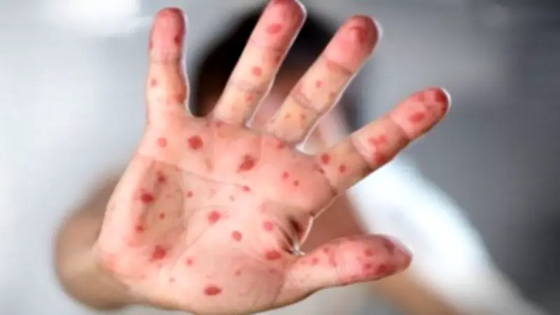 রাজশাহীতে হামে শিশুমৃত্যু, তেজগাঁওয়ে শ্রমিক অবরোধ প্রত্যাহার, কুমিল্লায় বাসে আগুন