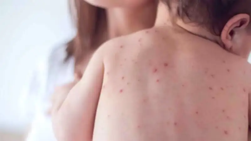 ময়মনসিংহে হামের প্রাদুর্ভাবে শিশুর মৃত্যু, ২৪ ঘণ্টায় ২৮ জন ভর্তি