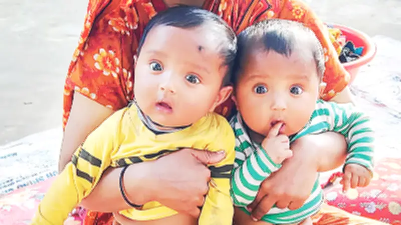 হামের আক্রমণে যমজ শিশু হাসানের মৃত্যু, হোসেনের চিকিৎসা আটকে অর্থকষ্টে