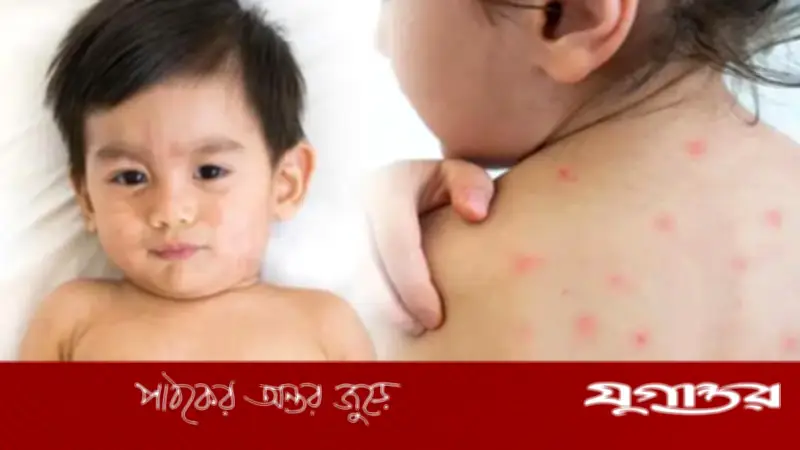 হাম নিয়ে আতঙ্ক নয়, সচেতনতাই মূল সমাধান: ডা. মারুফা রহমানের পরামর্শ