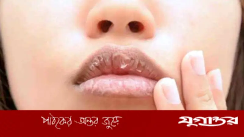 গ্রীষ্মকালেও ঠোঁট ফাটার সমস্যা: বিশেষ যত্নের সহজ উপায়
