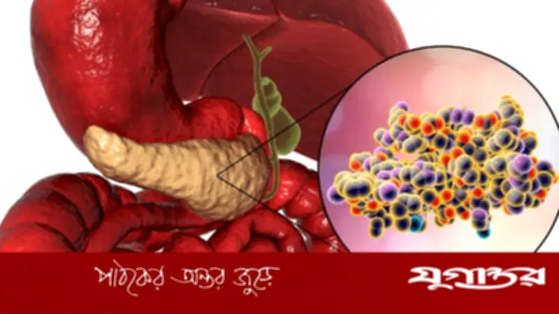 অগ্ন্যাশয় ক্যান্সার চিকিৎসায় যুগান্তকারী আবিষ্কার: নতুন ট্যাবলেটে মৃত্যুঝুঁকি ৬০% কমে