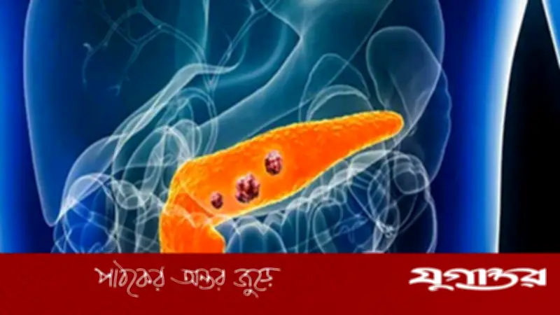 অগ্ন্যাশয় ক্যানসারের চিকিৎসায় নতুন পিল: মৃত্যুঝুঁকি ৬০% কমাতে পারে