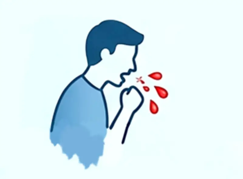 কাশির সঙ্গে রক্ত পড়া: কারণ, পার্থক্য ও জরুরি করণীয়