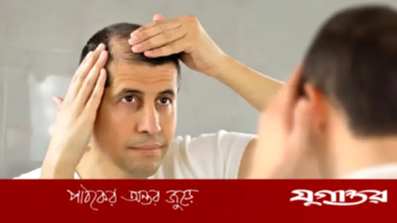 ডিএইচটি হেয়ার লস: চুল পড়ার জেনেটিক কারণ ও সমাধান