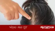 চুল পড়ার পেছনের ৫টি প্রধান কারণ: পুষ্টির ঘাটতি থেকে সাবধান