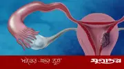 অনিয়মিত ঋতুস্রাব জরায়ুর ক্যানসারের সতর্ক সংকেত হতে পারে