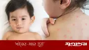 শিশুদের হামের প্রকোপ বাড়ছে: অভিভাবকদের জন্য জরুরি নির্দেশনা