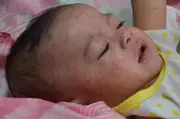 রুবেলা রোগের লক্ষণ, সংক্রমণ ও প্রতিরোধ: গর্ভবতী মায়েদের জন্য বিশেষ সতর্কতা