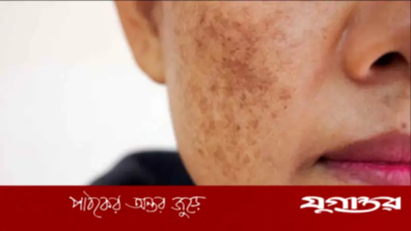 গালের মেছতা দূর করবে ফিটকিরি, জেনে নিন ব্যবহারের সঠিক পদ্ধতি