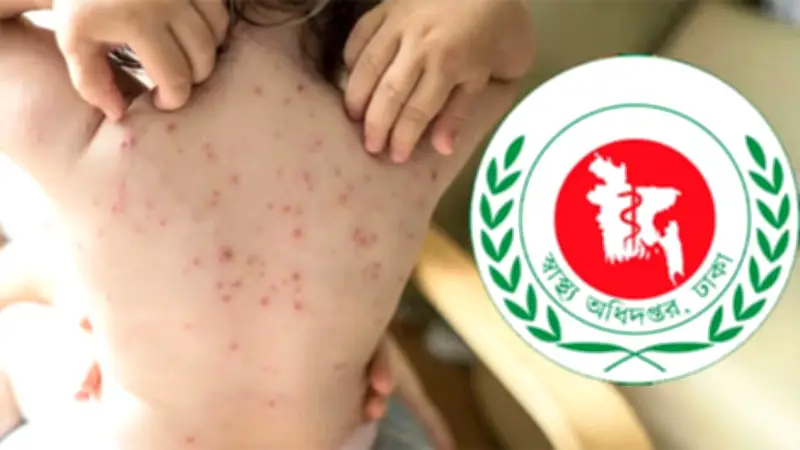 সারাদেশে হাম উপসর্গে আরো ৬ জনের মৃত্যু, ইবোলা বৈশ্বিক জরুরি অবস্থা