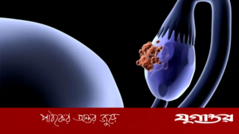 পঞ্চাশোর্ধ্ব নারীদের ডিম্বাশয় ক্যান্সারের ঝুঁকি বেশি: বিশেষজ্ঞ
