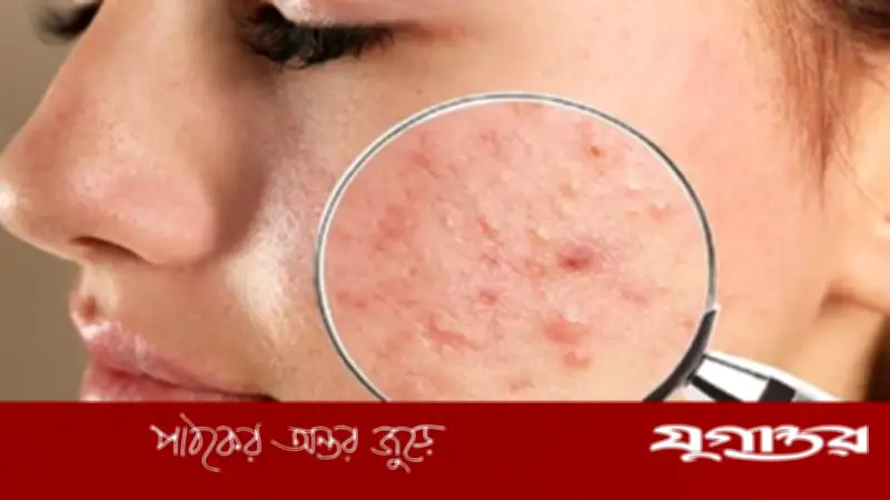 মানসিক চাপের প্রভাব: ব্রণ ও চর্মরোগের কারণ ও প্রতিকার