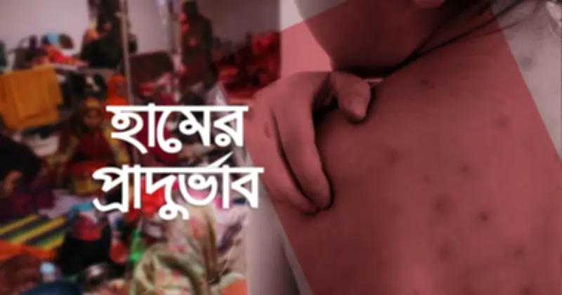 ২৪ ঘণ্টায় হামে আরও ১৭ মৃত্যু, আক্রান্ত ১ হাজার ৩০২