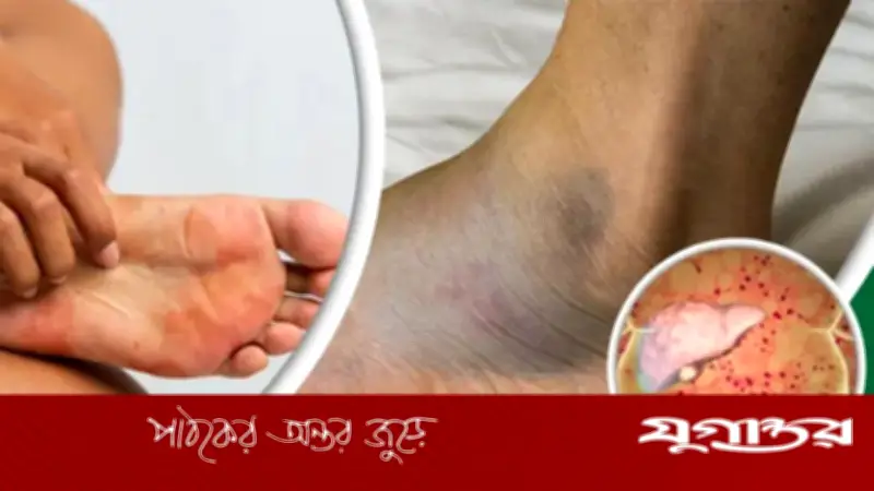 পায়ের পাতা দেখে লিভারের সমস্যা চিহ্নিত করুন, জানুন লক্ষণগুলো