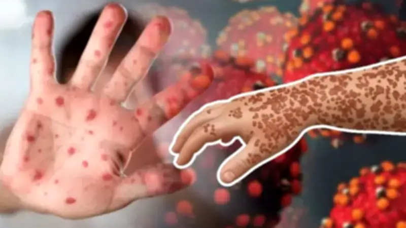 হাম ও উপসর্গে আরও ৭ জনের মৃত্যু