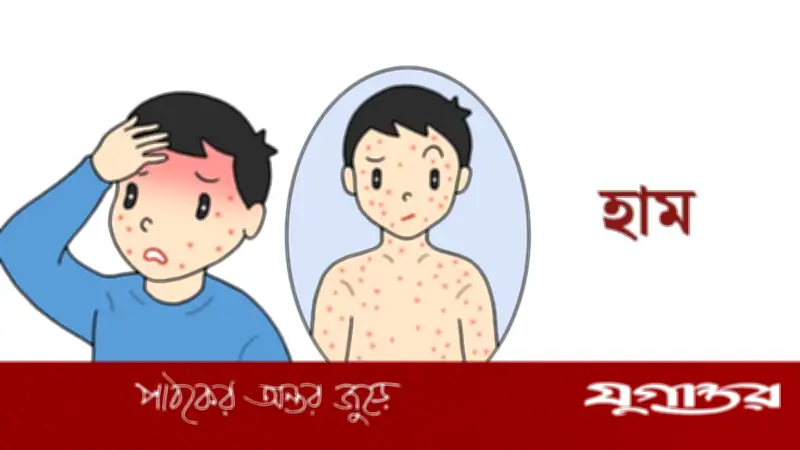ময়মনসিংহে হামে আরও এক শিশুর মৃত্যু, চিকিৎসাধীন ৯৬