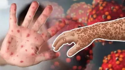 হাম ও উপসর্গে আরও ৬ শিশুর মৃত্যু, বিদ্যুৎমন্ত্রী বললেন গ্রামে লোডশেডিং নেই