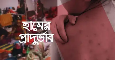 ২৪ ঘণ্টায় হাম ও উপসর্গে ১১ জনের মৃত্যু, মোট ৪০৯