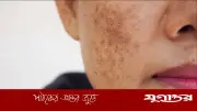 গালের মেছতা দূর করবে ফিটকিরি, জেনে নিন ব্যবহারের সঠিক পদ্ধতি