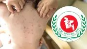 সারাদেশে হাম উপসর্গে আরো ৬ জনের মৃত্যু, ইবোলা বৈশ্বিক জরুরি অবস্থা