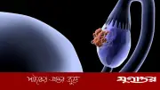 পঞ্চাশোর্ধ্ব নারীদের ডিম্বাশয় ক্যান্সারের ঝুঁকি বেশি: বিশেষজ্ঞ