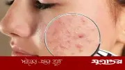 মানসিক চাপের প্রভাব: ব্রণ ও চর্মরোগের কারণ ও প্রতিকার