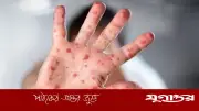 ময়মনসিংহে হামে আরও এক শিশুর মৃত্যু, চিকিৎসাধীন ৭৯