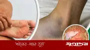 পায়ের পাতা দেখে লিভারের সমস্যা চিহ্নিত করুন, জানুন লক্ষণগুলো