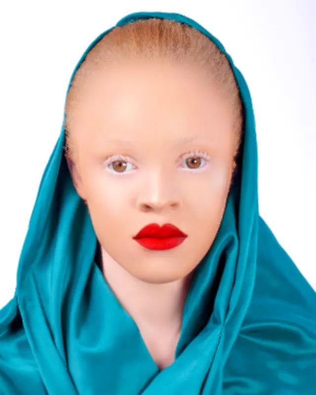 অ্যালবিনিজম: কারণ, লক্ষণ ও সচেতনতা