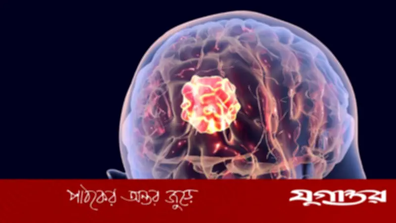 ব্রেন টিউমারের ৬টি প্রাথমিক লক্ষণ যা উপেক্ষা করবেন না