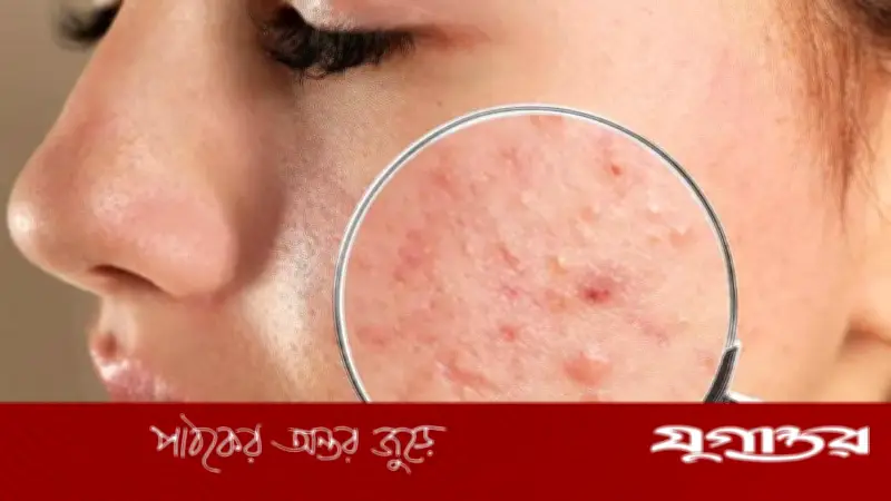 মুখে ব্রণের সমস্যা দূর করতে ঘরোয়া উপায়